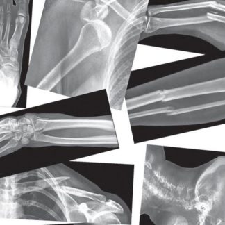 Broken Bones X-Rays