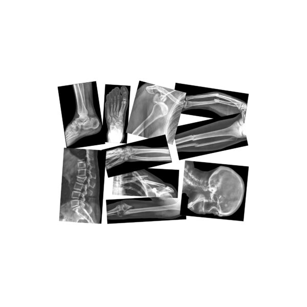 Broken Bones X-Rays