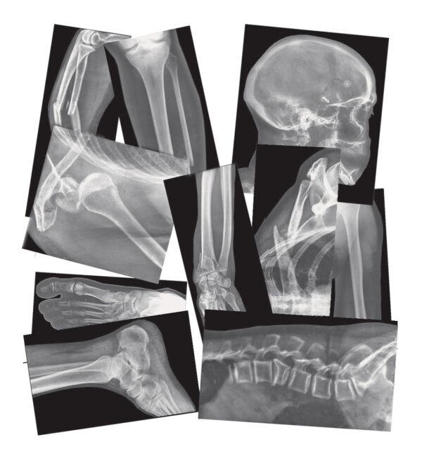 Broken Bones X-Rays - Image 2